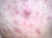 Como Desinflamar Barro