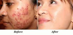 Como Quitar Barros y Espinillas Rapido