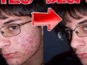 Como Quitar Barros Espinillas Rapido Facil