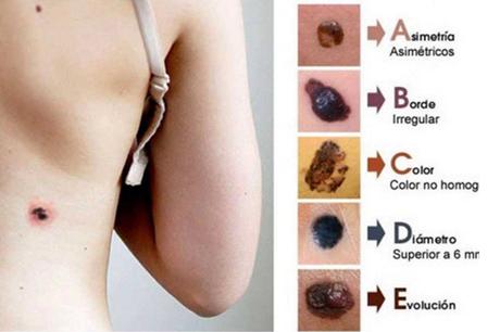 #Salud:   Estas son las características de los #lunares que pueden ser #cáncer