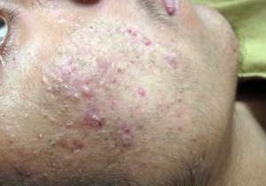 como quitar barros enterrados en la cara Como Quitar Barros Enterrados En La Cara