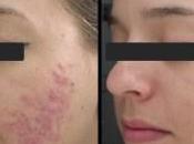 Como Eliminar Barros: Tres Potentes Remedios Naturales