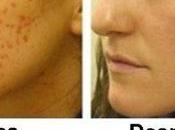 Como Quitar Marcas Acne?