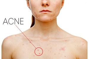 Como Quitar El Acne Del Pecho? Como Quitar El Acne Del Pecho?