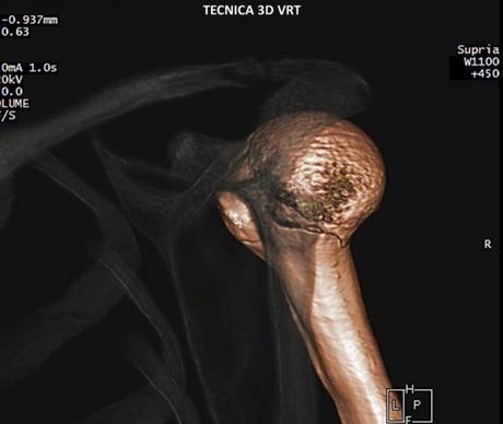 Caso clínico de Fractura de hombro por tomografía imagen 3d vrt