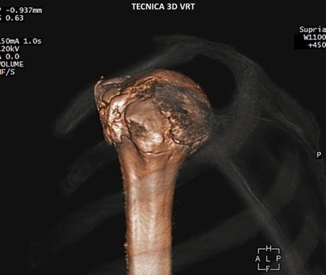 Caso clínico de Fractura de hombro por tomografía imagen 3d vrt