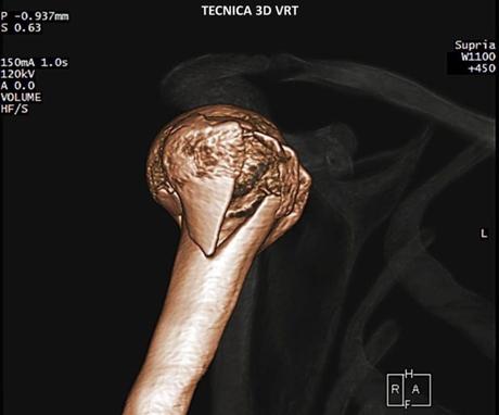 Caso clínico de Fractura de hombro por tomografía imagen 3d vrt