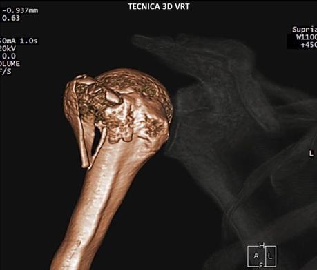 Caso clínico de Fractura de hombro por tomografía imagen 3d vrt