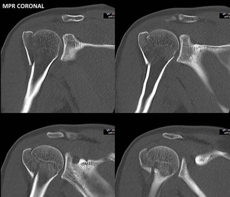 Caso clínico de Fractura de hombro por tomografía imagen 3d vrt