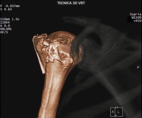 Caso clínico de Fractura de hombro por tomografía imagen 3d vrt