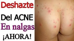Como Quitar El Acne En Los Gluteos? Como Quitar El Acne En Los Gluteos?