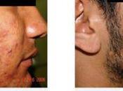 Como Eliminar Acne Rapido Adultos