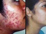 Como Quitar Acne Severo Casa