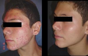 Como Quitar El acne Con Remedios Caseros