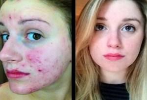 Como Quitar El Acne Quistico?
