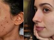 Como Quitar Acne Espinillas Rapido