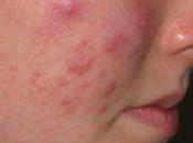 Como Desaparecer Espinillas