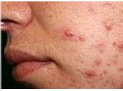 Como Quitar Granos Dela Cara Rapido