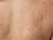 Como Evitar Acne Espalda
