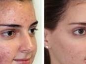 Como Quitar Acne Para Siempre Reduciendo Hormonas