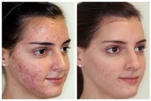 Como Quitar El Acne Para Siempre Reduciendo Las Hormonas