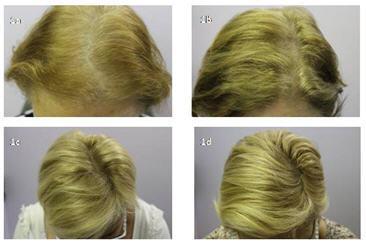 Serenoa repens contra la caída del cabello. Los estudios lo verifican Serenoa repens contra la caída del cabello. Los estudios lo verifican