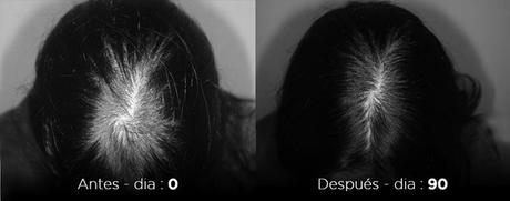 Serenoa repens lamdapil Serenoa repens lamdapil