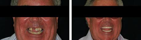 Implantes cigomáticos