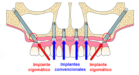 Implantes de huesos e injertos de huesos