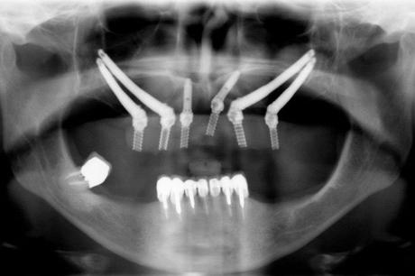 Implantes cigomáticos