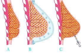 Lipofillling, aumento de pecho con grasa Lipofillling, aumento de pecho con grasa