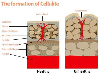 Cómo se forma la celulitis