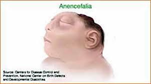 Anencefalia. Ácido fólico