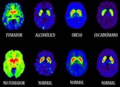 Efecto de varias drogas en el cerebro