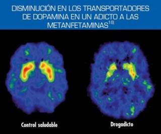 Efecto de las metanfetaminas en el cerebro
