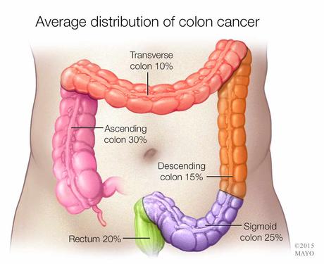 Cáncer de colon: descubren un nuevo gen para su tratamiento Cáncer de colon: descubren un nuevo gen para su tratamiento