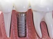 pierden piezas dentales puedas imaginar