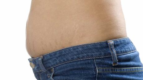 Estrías: combatirlas con remedios naturales