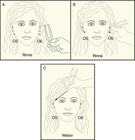 Pérdida de audición Pérdida de audición