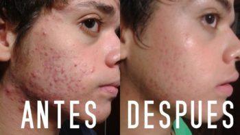 Como Quitar El Acne Para Siempre