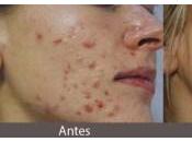 Como Eliminar Acne Remedios Caseros