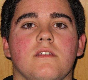 Como Desaparecer El Acne Desde El Interior