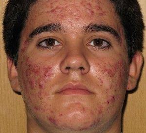 Como Desaparecer El Acne Desde El Interior
