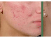 Como Eliminar Barros Enterrados Cara?