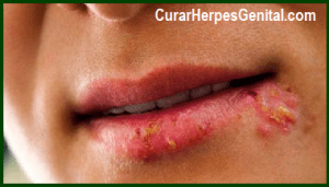 Fuego Labial Como Curarlo Naturalmente – Remedios Caseros