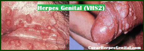 Tratamiento Para Herpes Super Efectivo 2018 Tratamiento Para Herpes Super Efectivo 2018