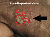 Herpes Genital Masculino Sintomas