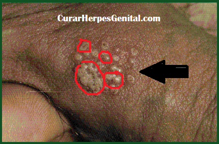 Herpes Genital Masculino Sintomas Paperblog