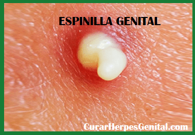 Herpes Genital, Granos o Espinillas Genitales?, Diferencias