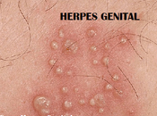 Herpes Genital, Granos Espinillas Genitales?, Diferencias